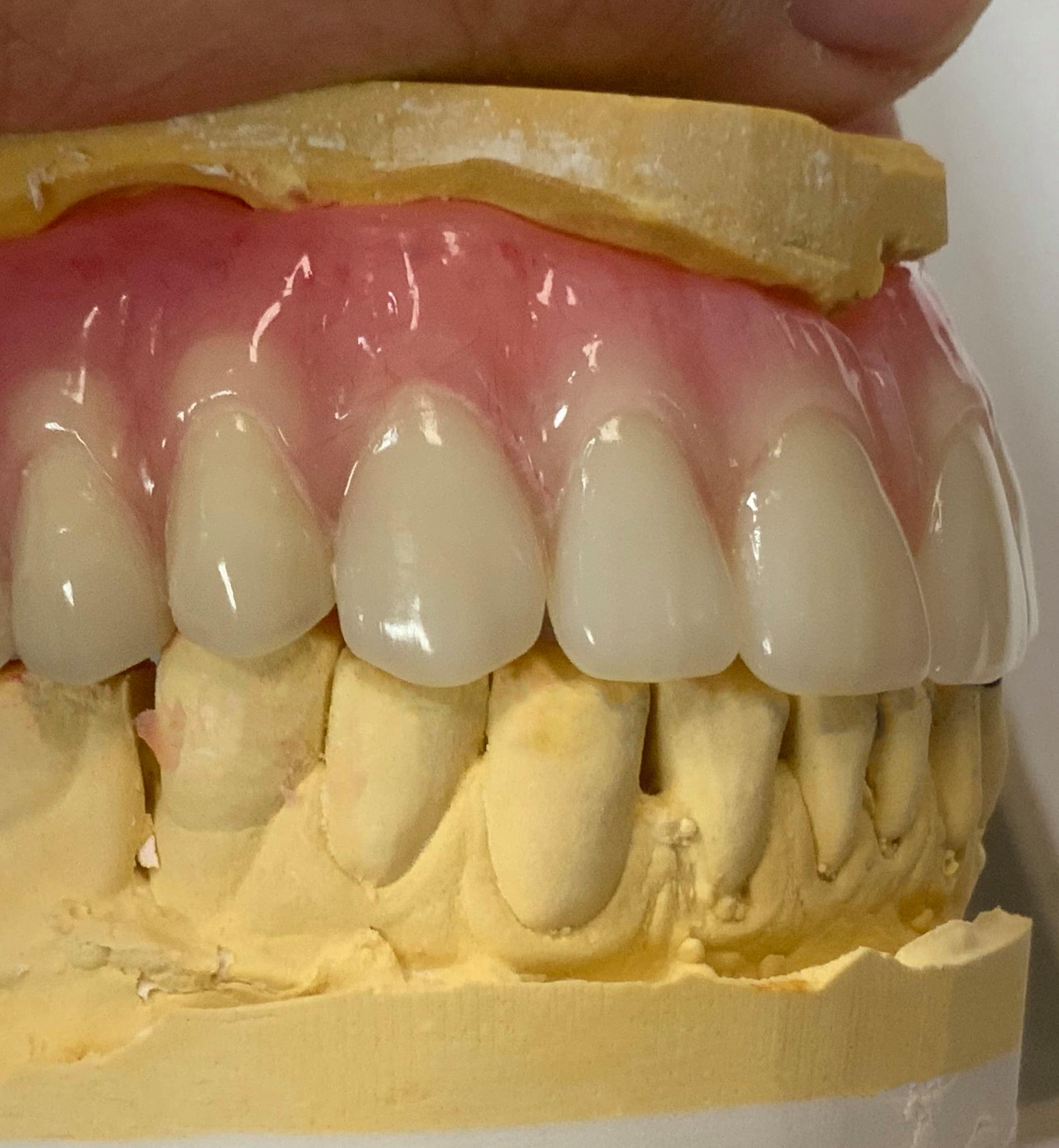 Partials/Dentures